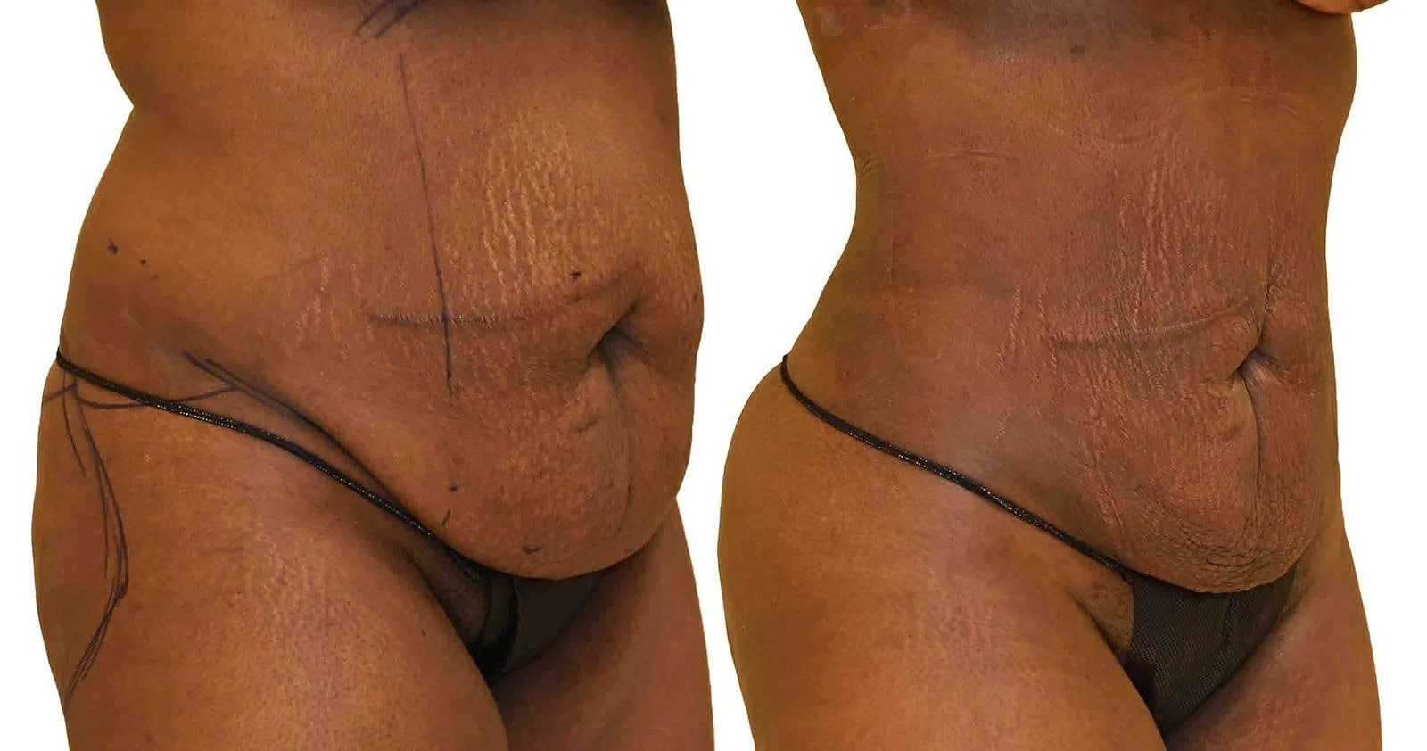 Lipo 360 before and after, actual patient of Dr. Long