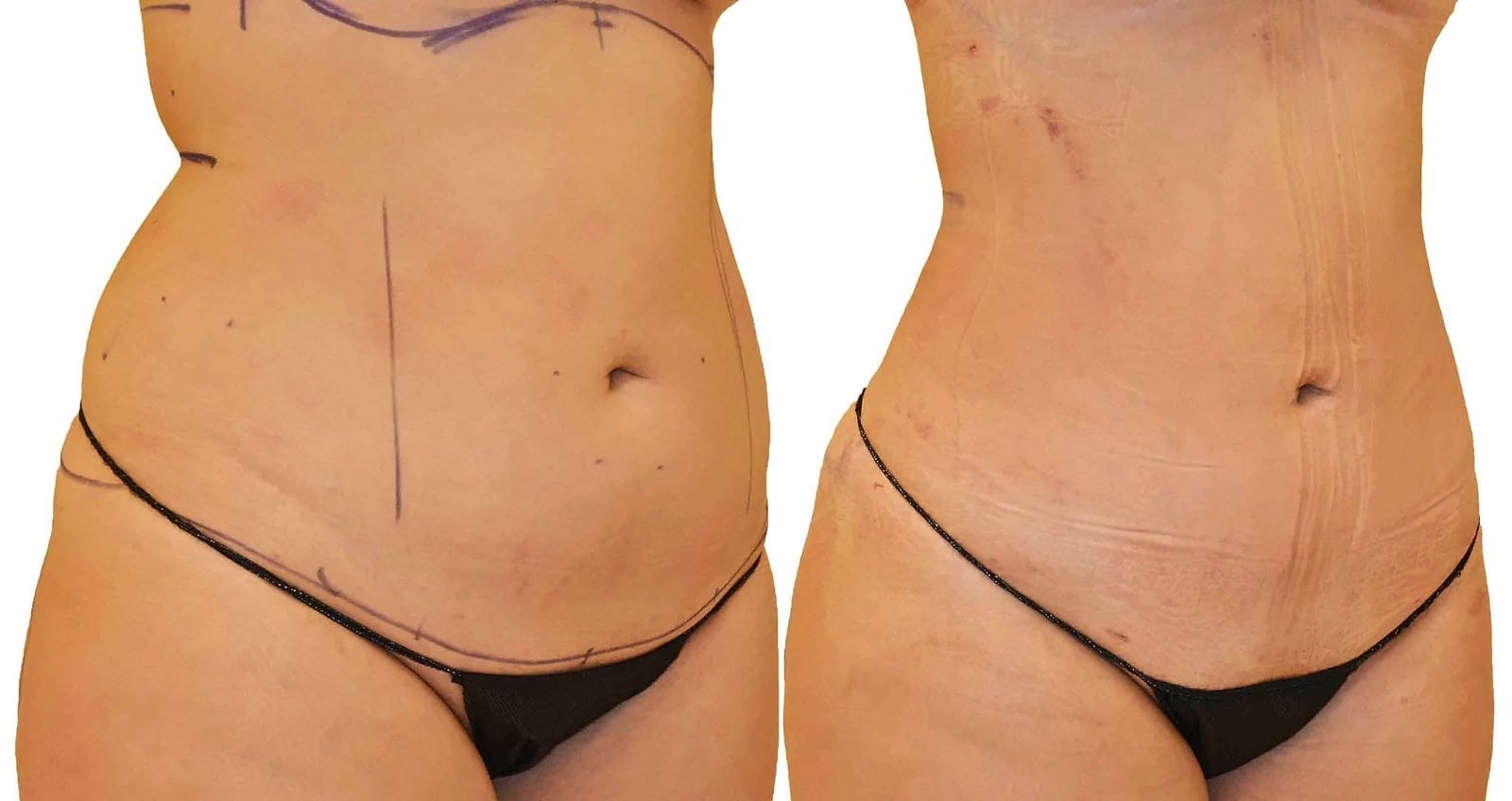 Lipo 360 before and after, actual patient of Dr. Long