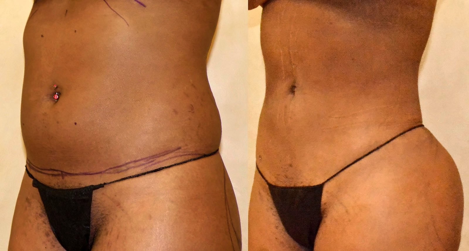 Lipo 360 before and after, actual patient of Dr. Long