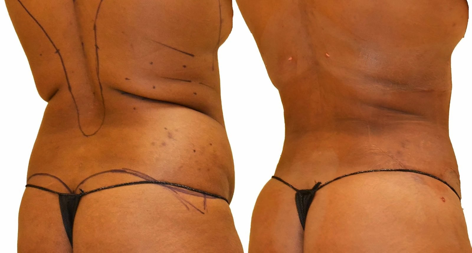 Fat Transfer, BBL before and after, actual patient of Dr. Long