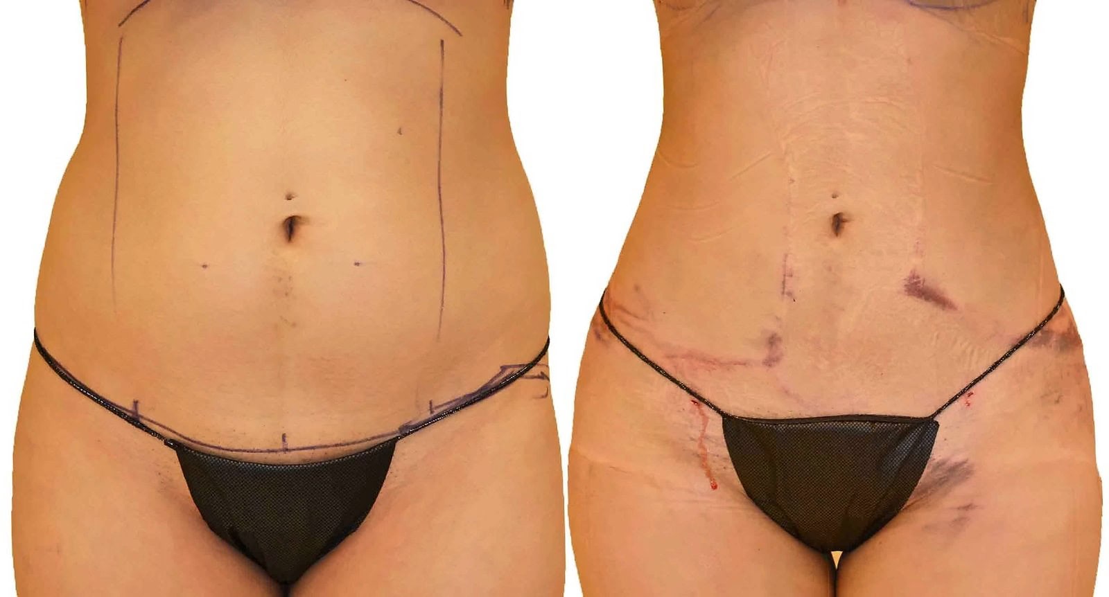 Lipo 360 before and after, actual patient of Dr. Long