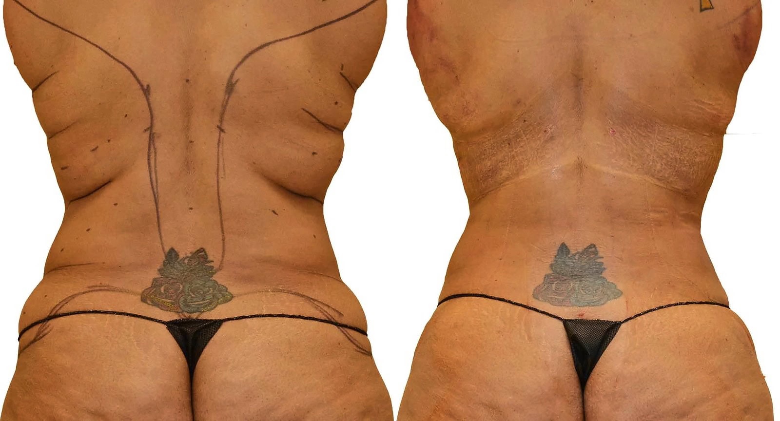 Fat Transfer, BBL before and after, actual patient of Dr. Long