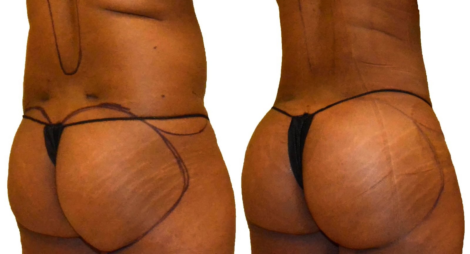 Fat Transfer, BBL before and after, actual patient of Dr. Long