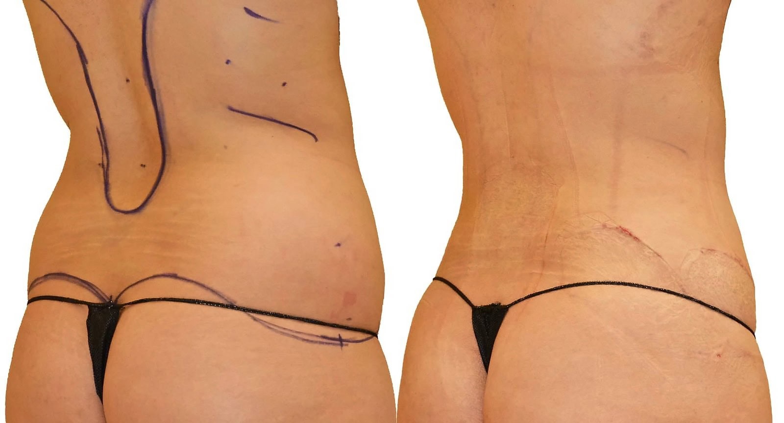 Lipo 360 before and after, actual patient of Dr. Long