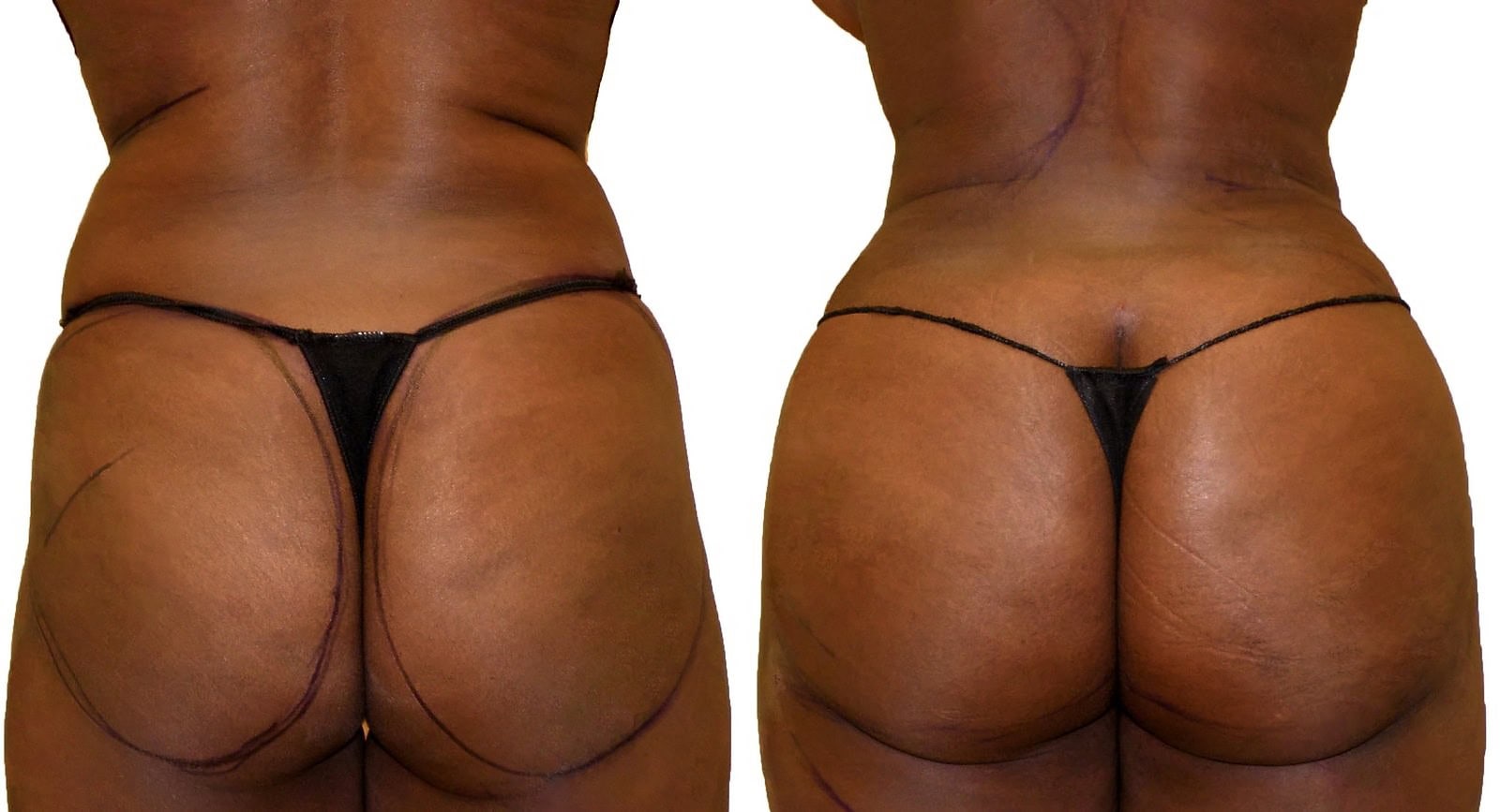 Fat Transfer, BBL before and after, actual patient of Dr. Long