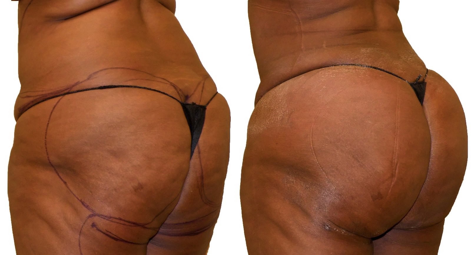 Fat Transfer, BBL before and after, actual patient of Dr. Long