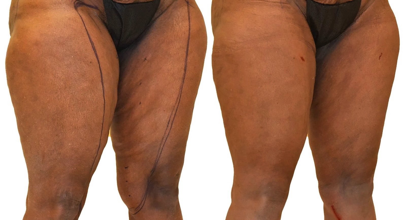 Thigh liposuction before and after, actual patient of Dr. Long
