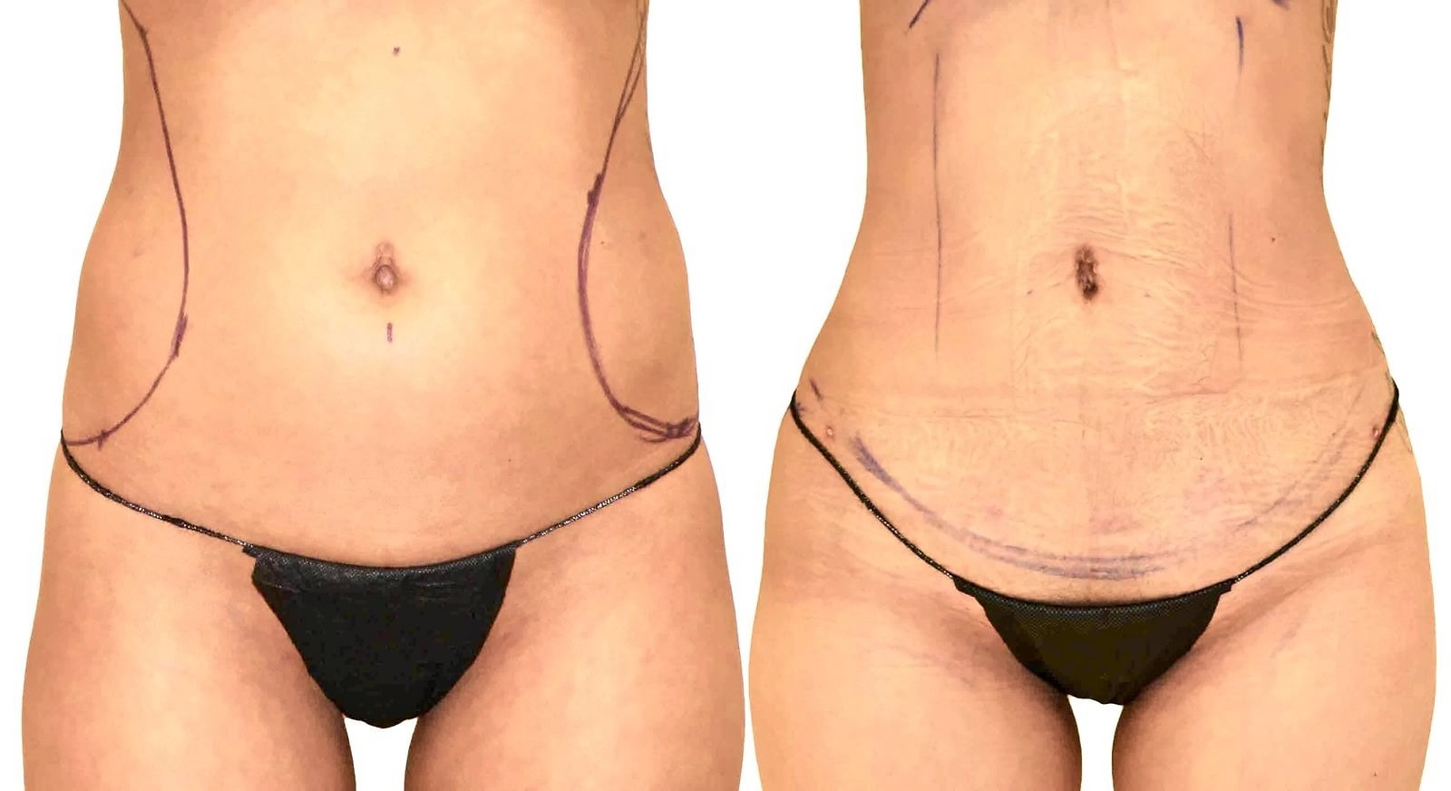 Lipo 360 before and after, actual patient of Dr. Long