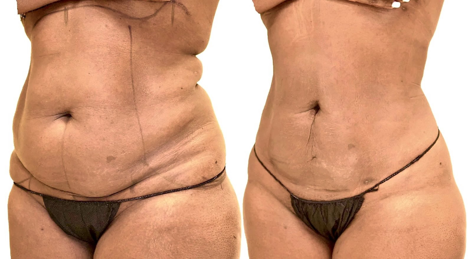 Lipo 360 before and after, actual patient of Dr. Long