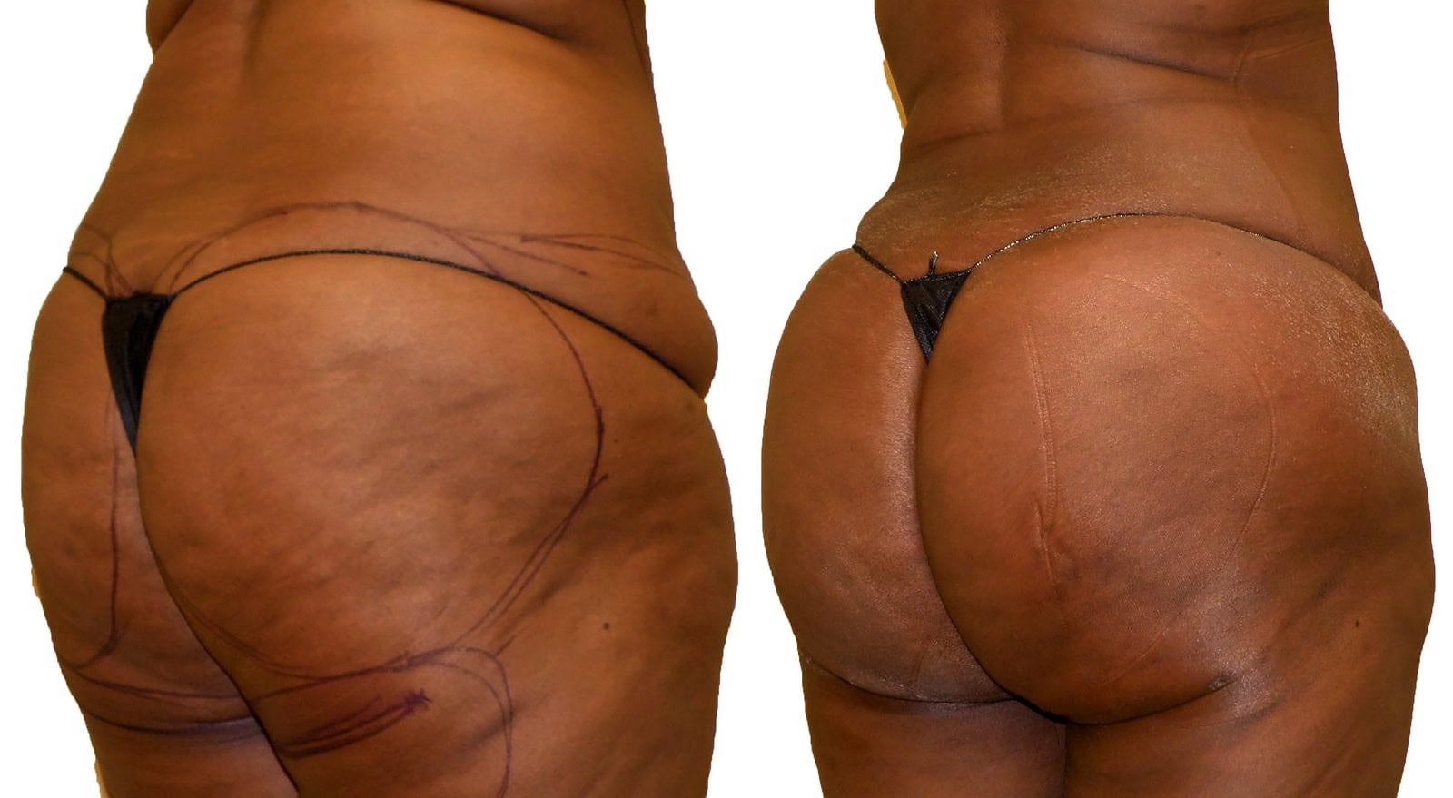 Fat Transfer, BBL before and after, actual patient of Dr. Long