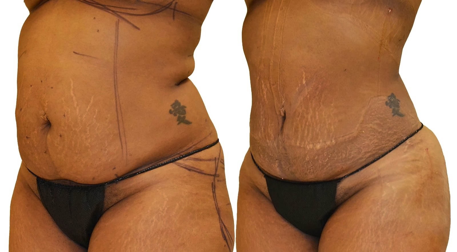 Lipo 360 before and after, actual patient of Dr. Long