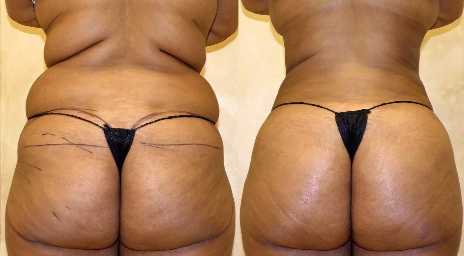 Fat Transfer, BBL before and after, actual patient of Dr. Long