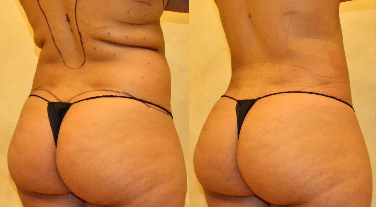 Fat Transfer, BBL before and after, actual patient of Dr. Long