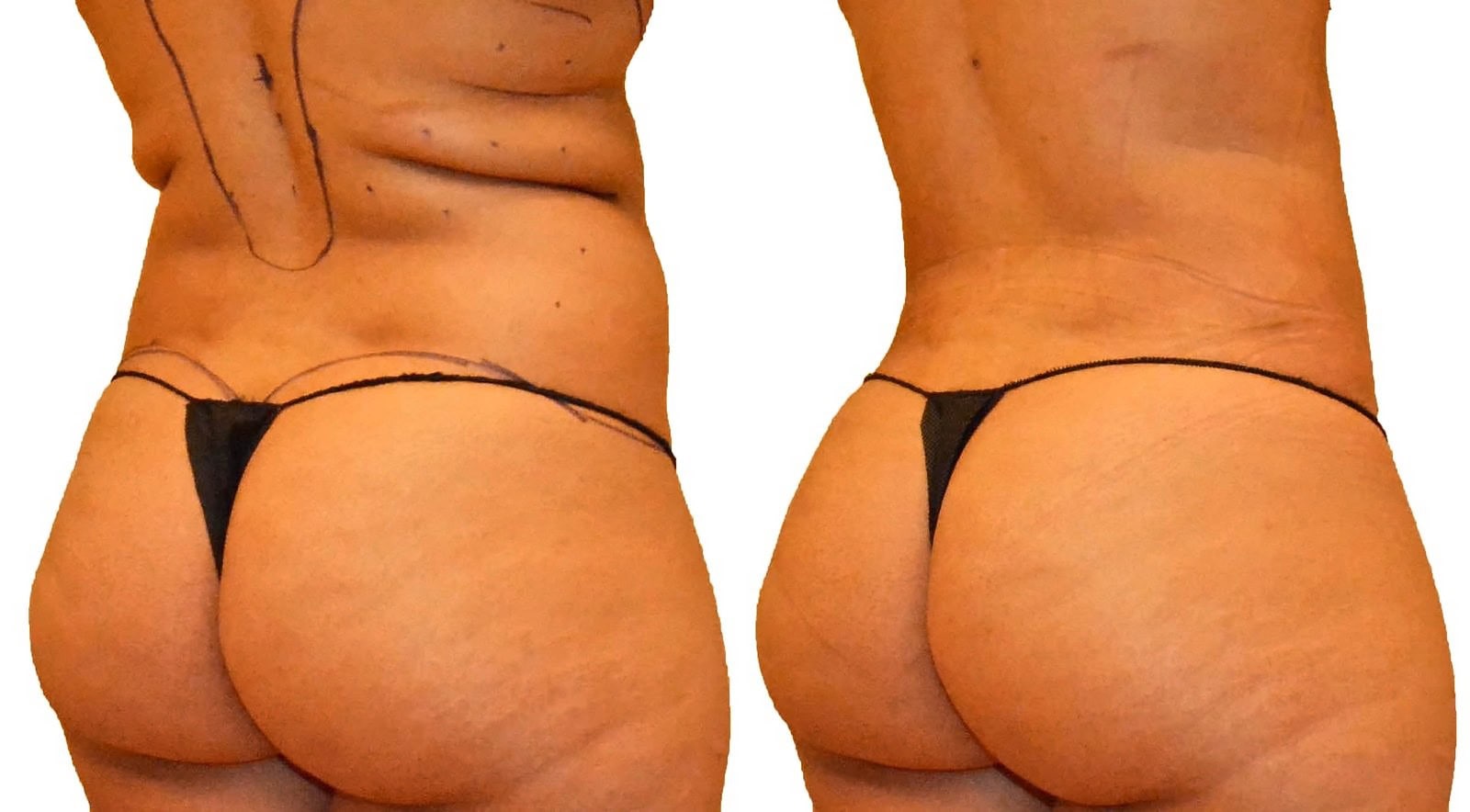 Fat Transfer, BBL before and after, actual patient of Dr. Long