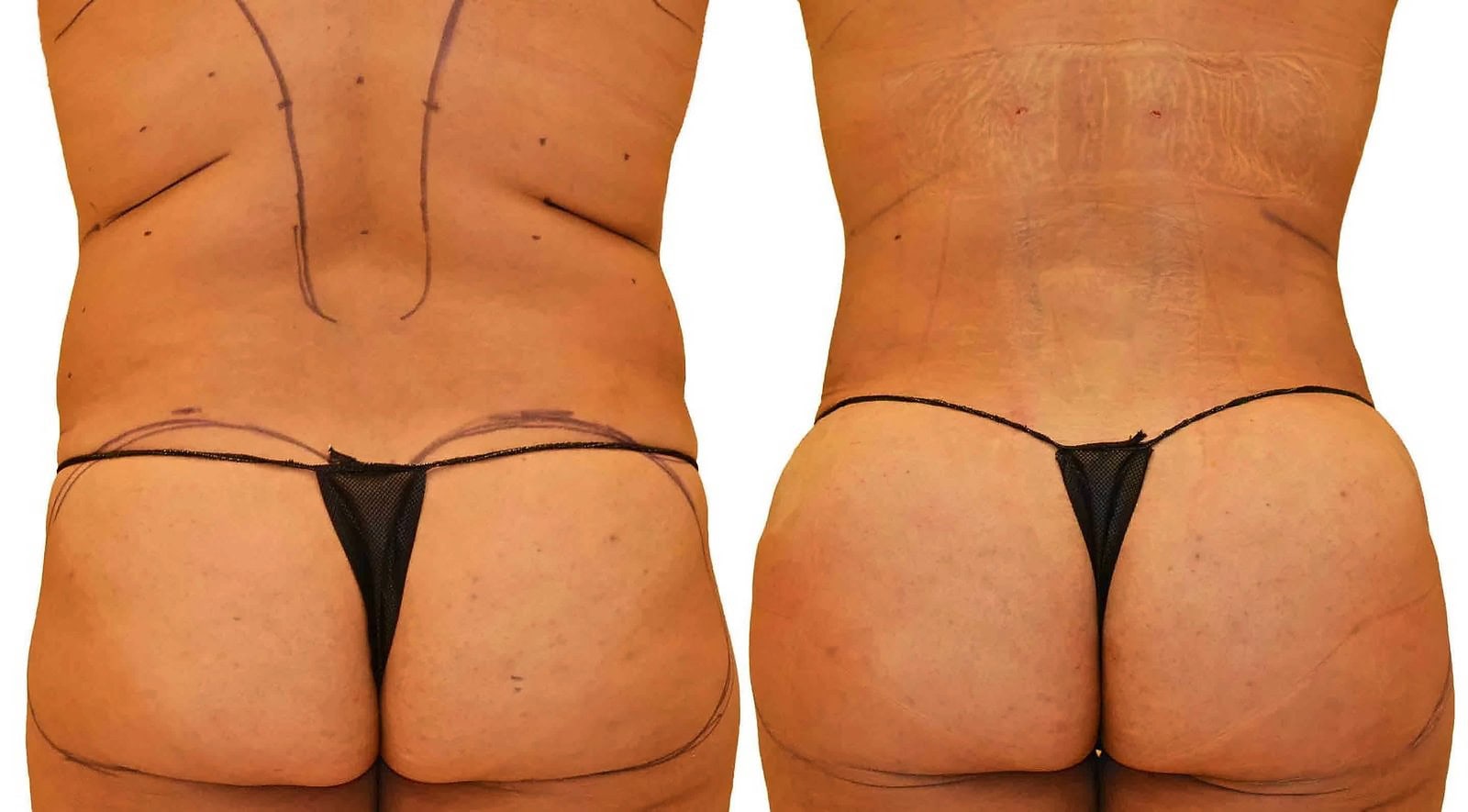 Fat Transfer, BBL before and after, actual patient of Dr. Long