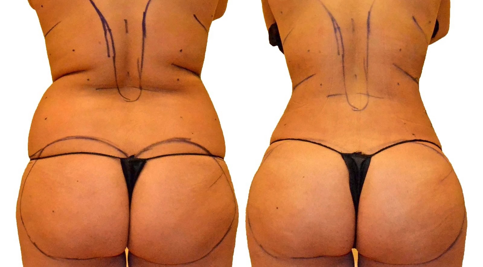 Fat Transfer, BBL before and after, actual patient of Dr. Long