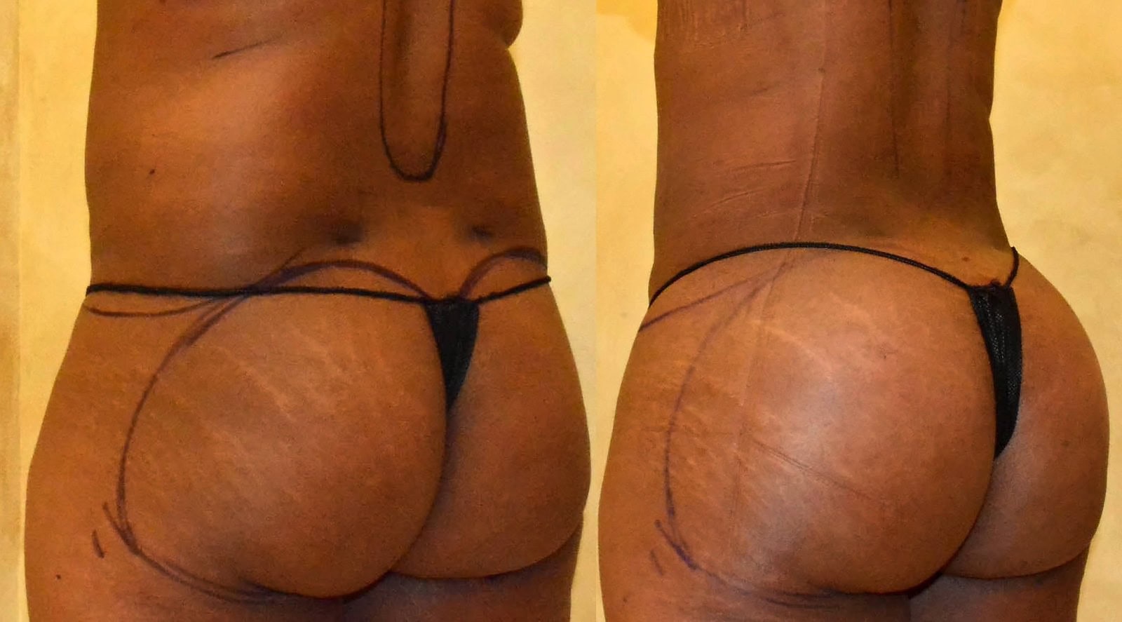 Fat Transfer, BBL before and after, actual patient of Dr. Long