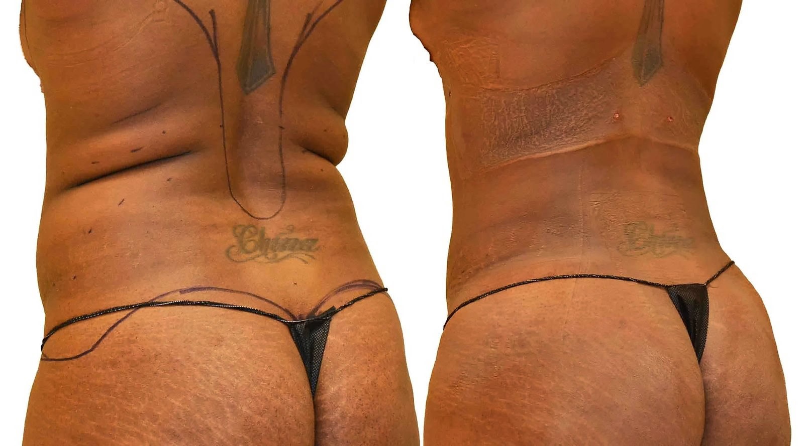 Fat Transfer, BBL before and after, actual patient of Dr. Long
