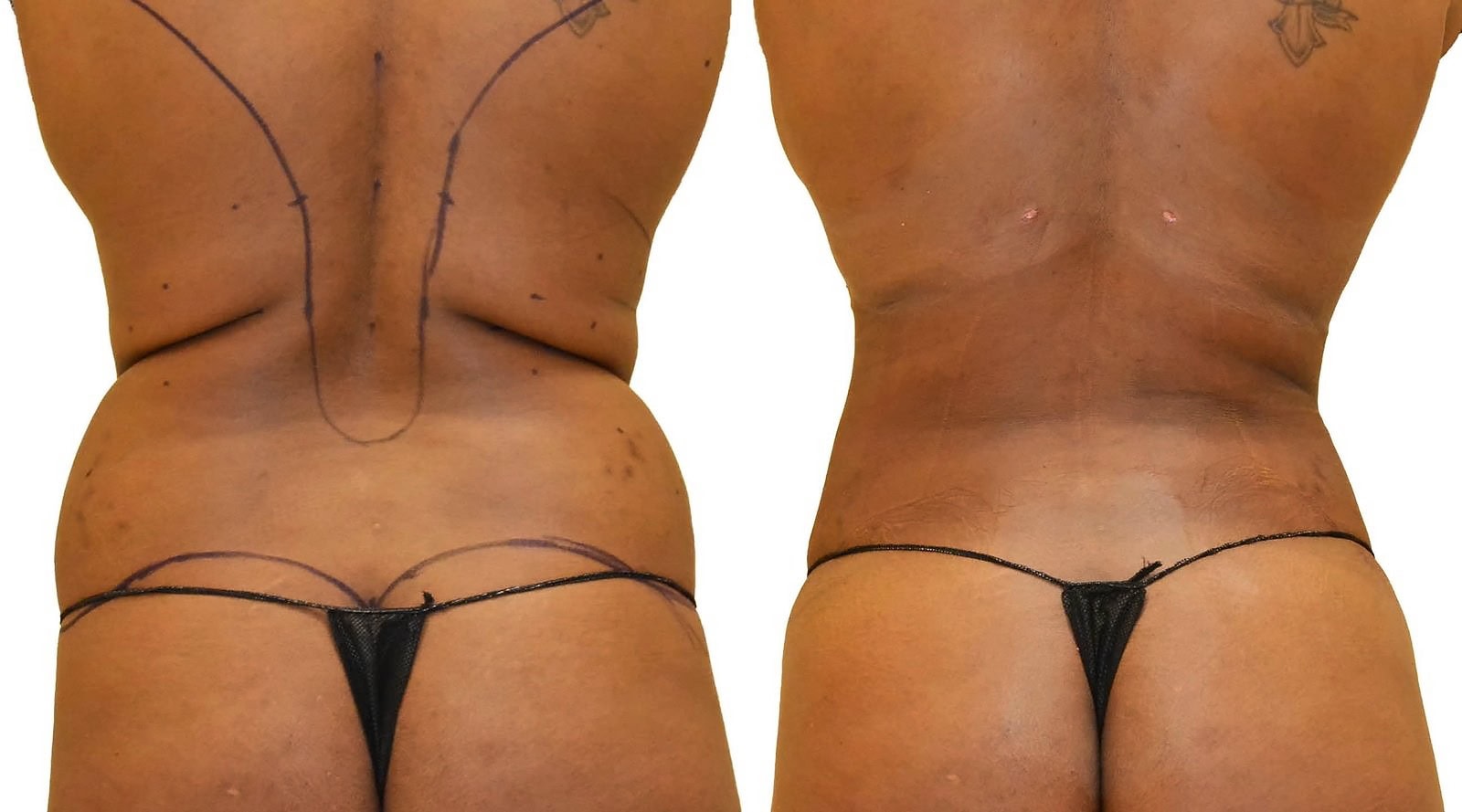 Fat Transfer, BBL before and after, actual patient of Dr. Long