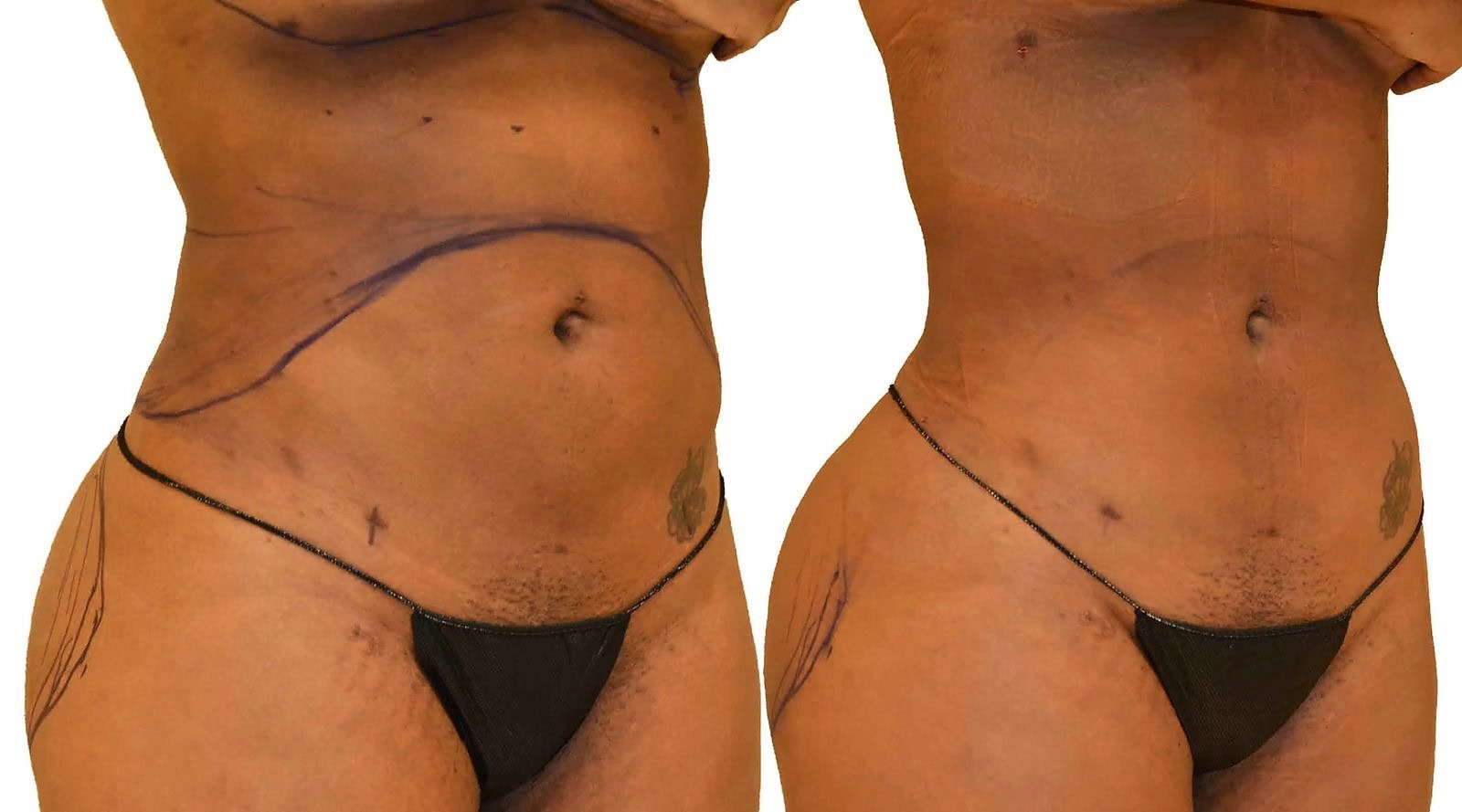 Lipo 360 before and after, actual patient of Dr. Long