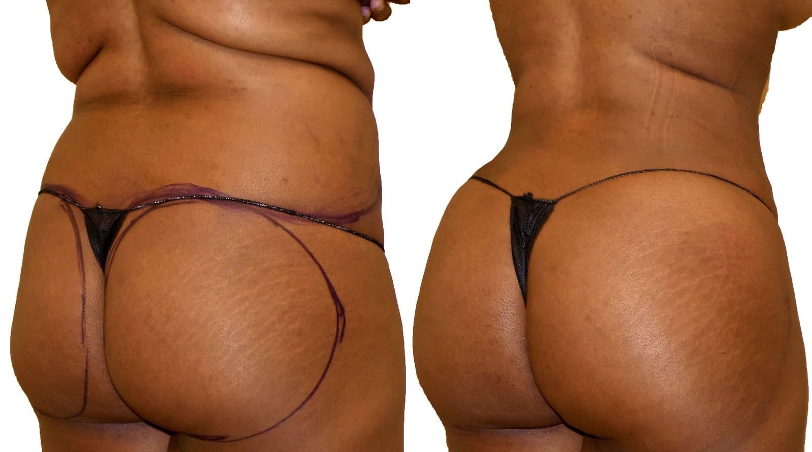 Fat Transfer, BBL before and after, actual patient of Dr. Long