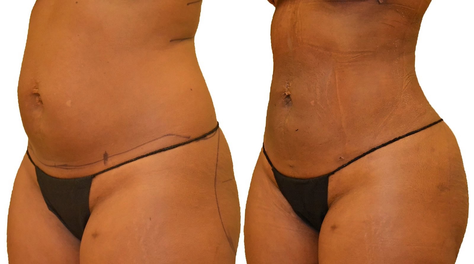 Lipo 360 before and after, actual patient of Dr. Long