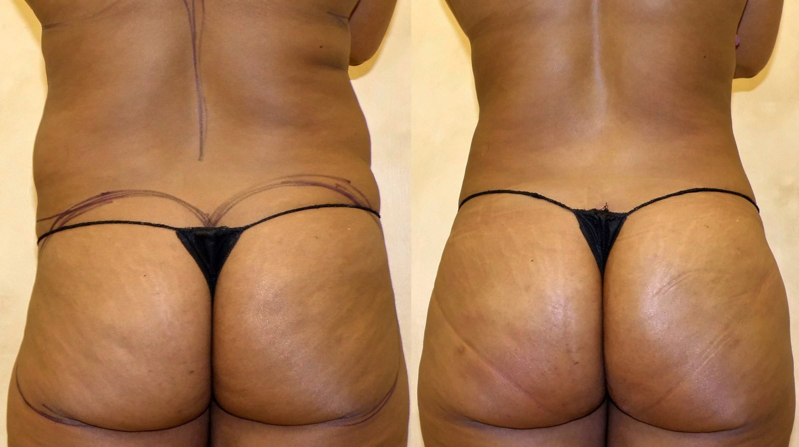 Fat Transfer, BBL before and after, actual patient of Dr. Long