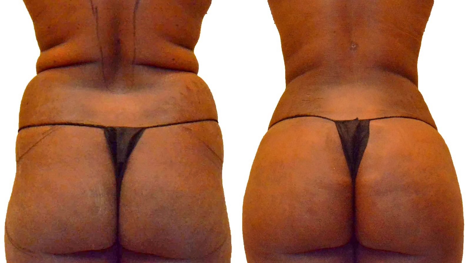 Fat Transfer, BBL before and after, actual patient of Dr. Long