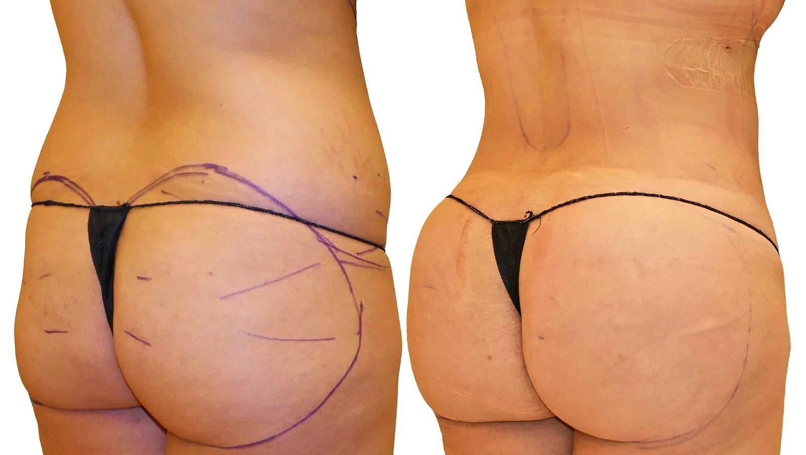 Fat Transfer, BBL before and after, actual patient of Dr. Long