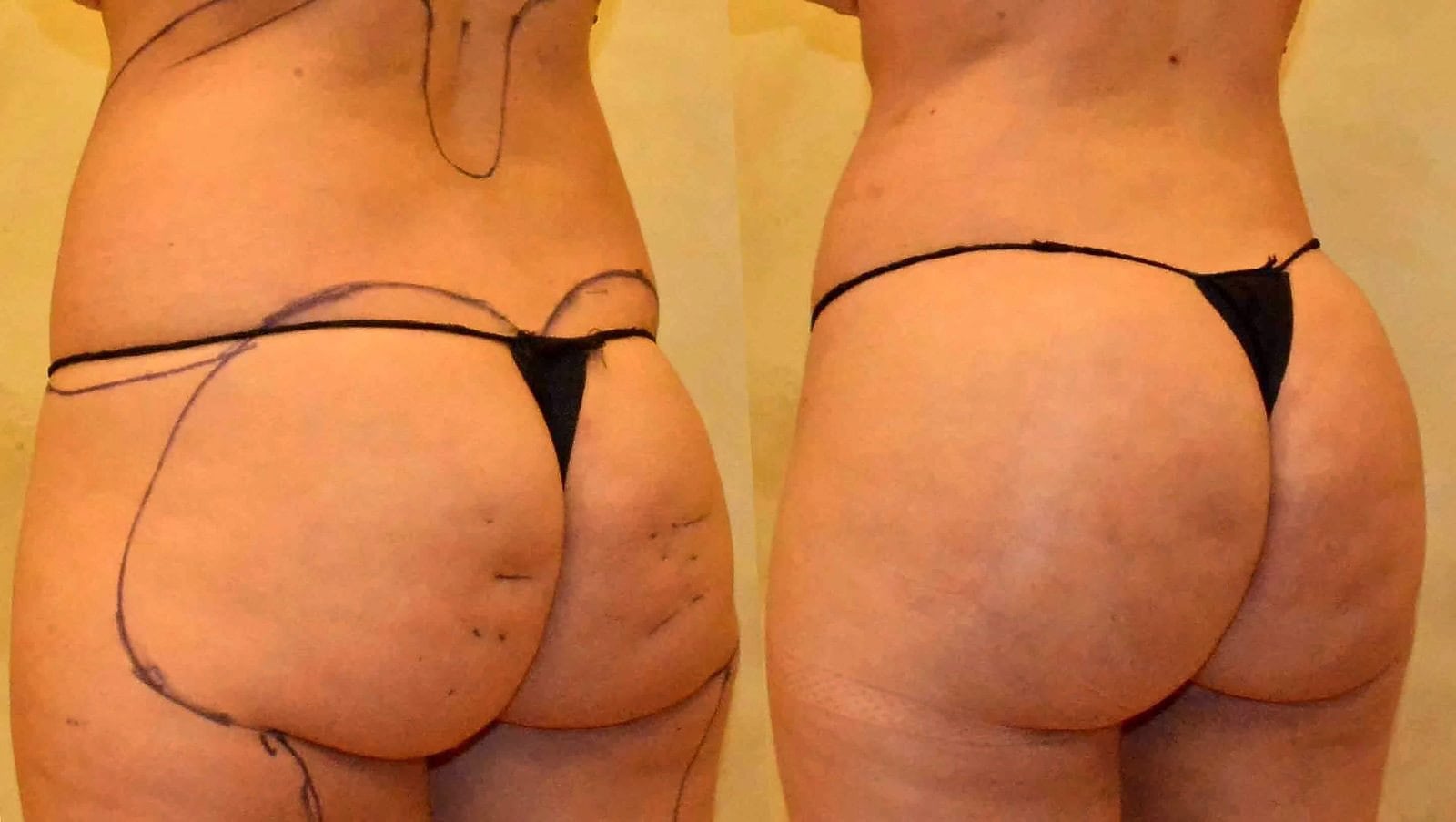 Fat Transfer, BBL before and after, actual patient of Dr. Long