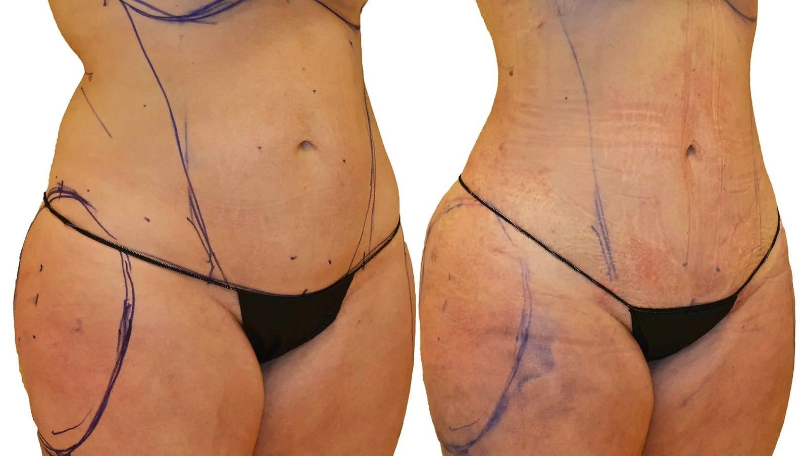 Lipo 360 before and after, actual patient of Dr. Long