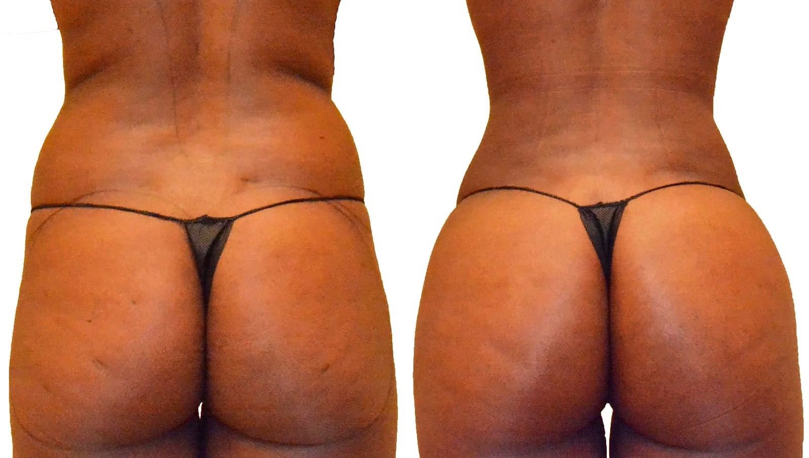 Fat Transfer, BBL before and after, actual patient of Dr. Long