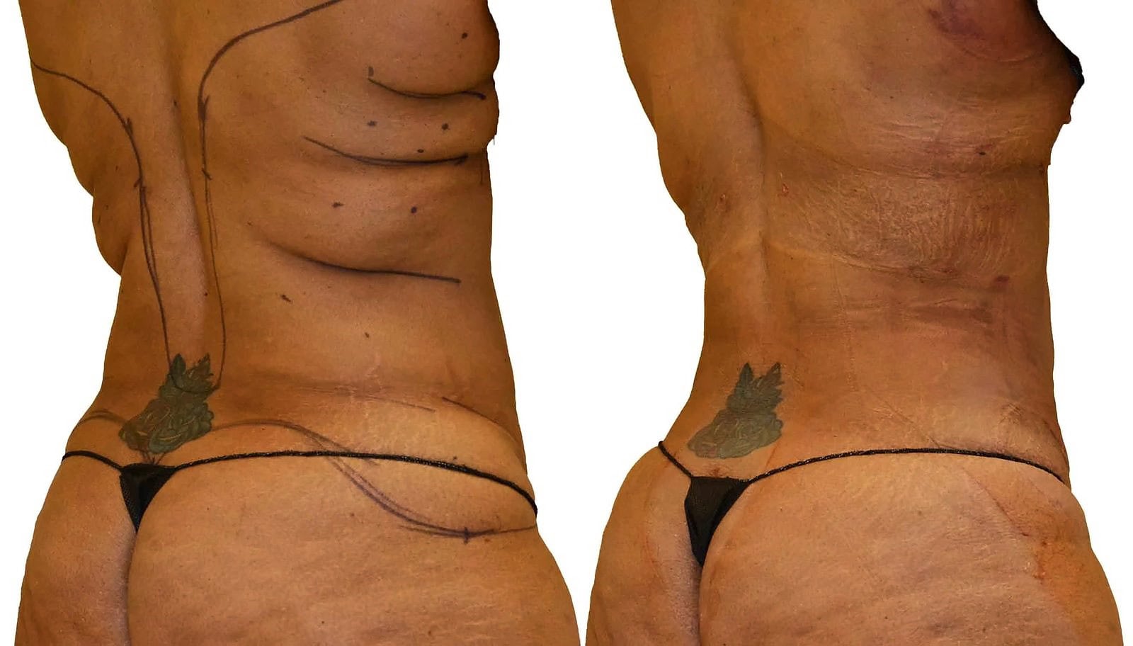 Lipo 360 before and after, actual patient of Dr. Long
