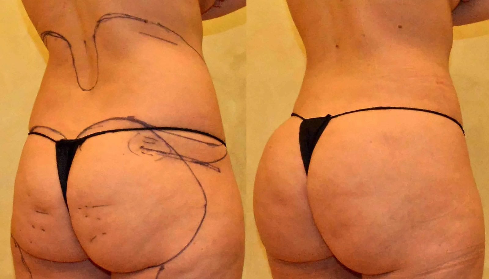 Fat Transfer, BBL before and after, actual patient of Dr. Long