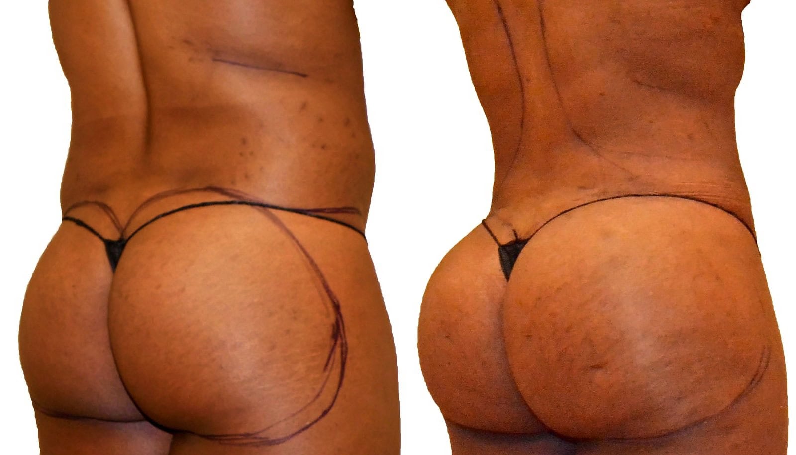 Fat Transfer, BBL before and after, actual patient of Dr. Long