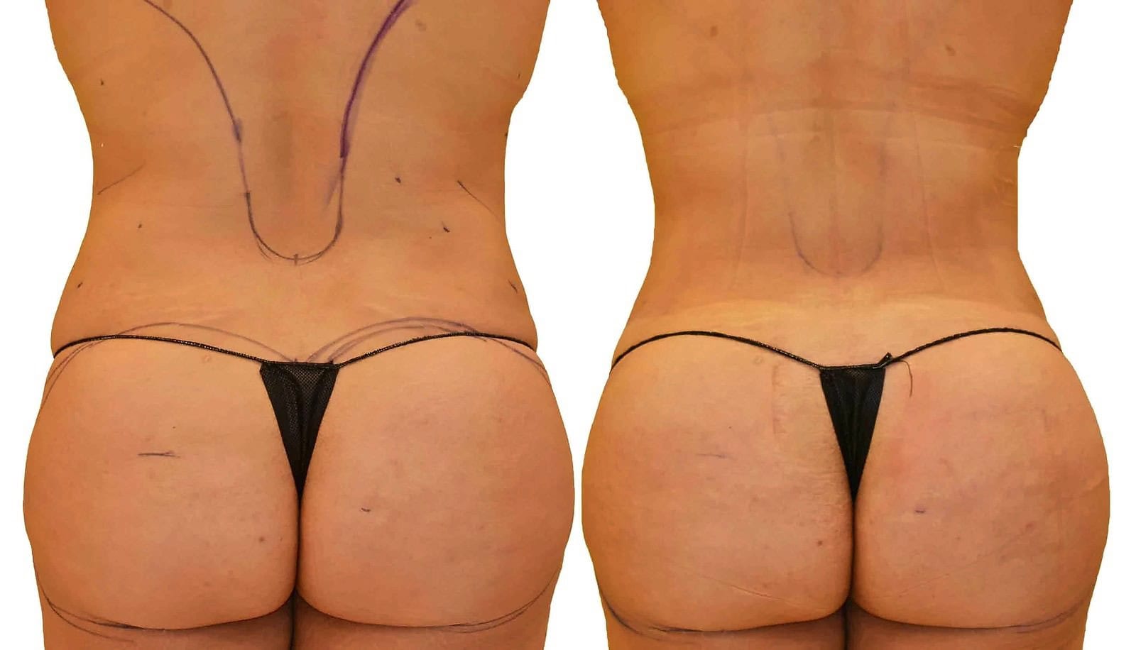 Fat Transfer, BBL before and after, actual patient of Dr. Long