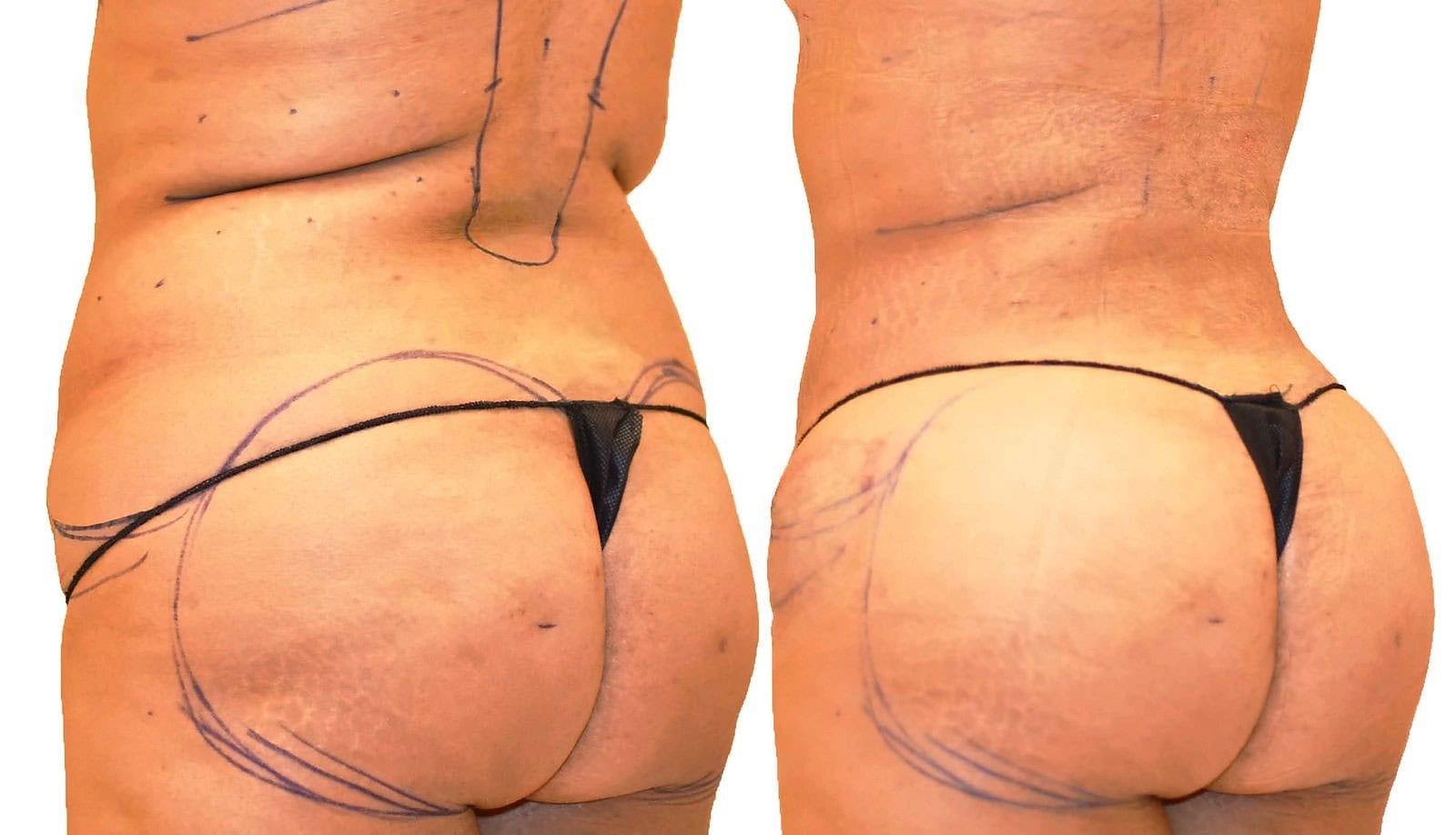 Fat Transfer, BBL before and after, actual patient of Dr. Long
