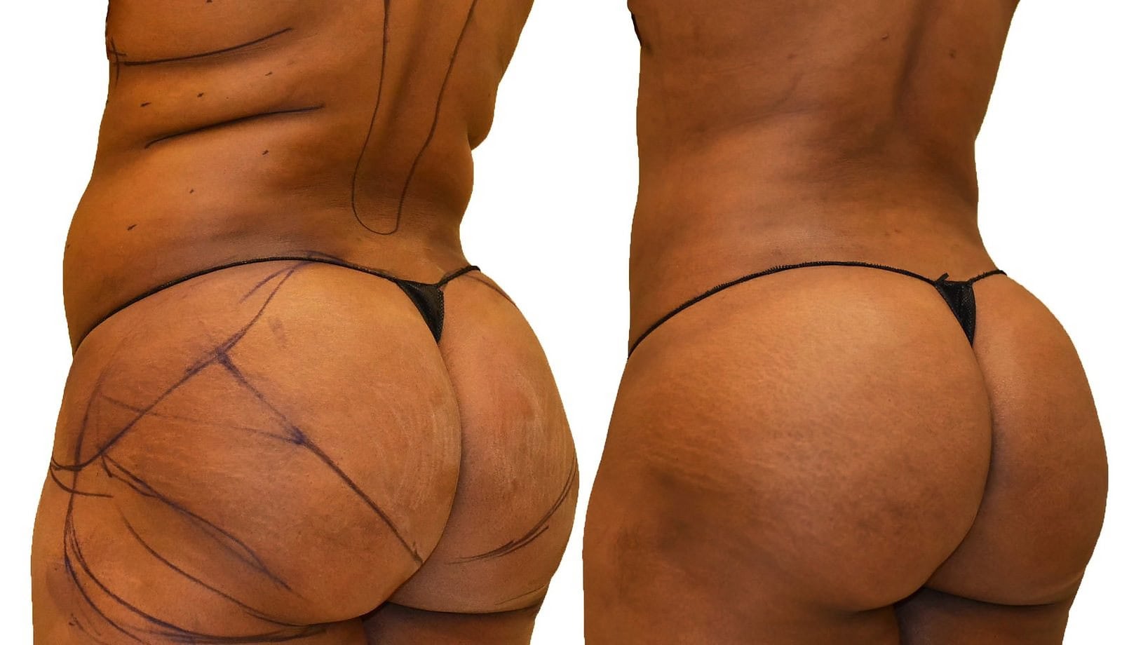 Fat Transfer, BBL before and after, actual patient of Dr. Long