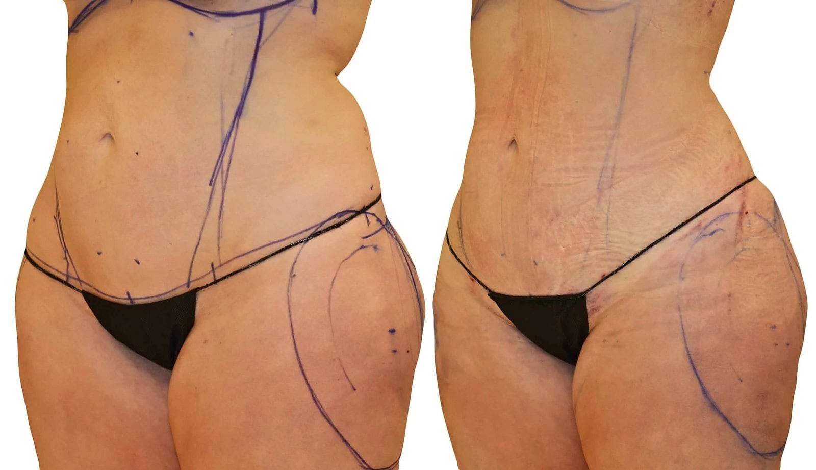 Lipo 360 before and after, actual patient of Dr. Long