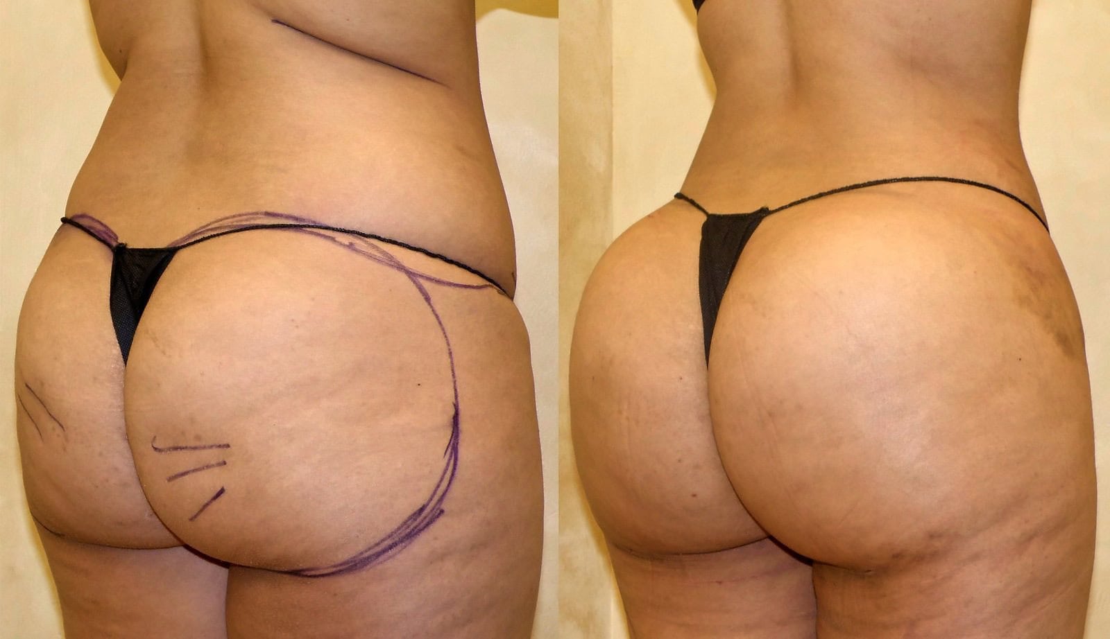 Fat Transfer, BBL before and after, actual patient of Dr. Long