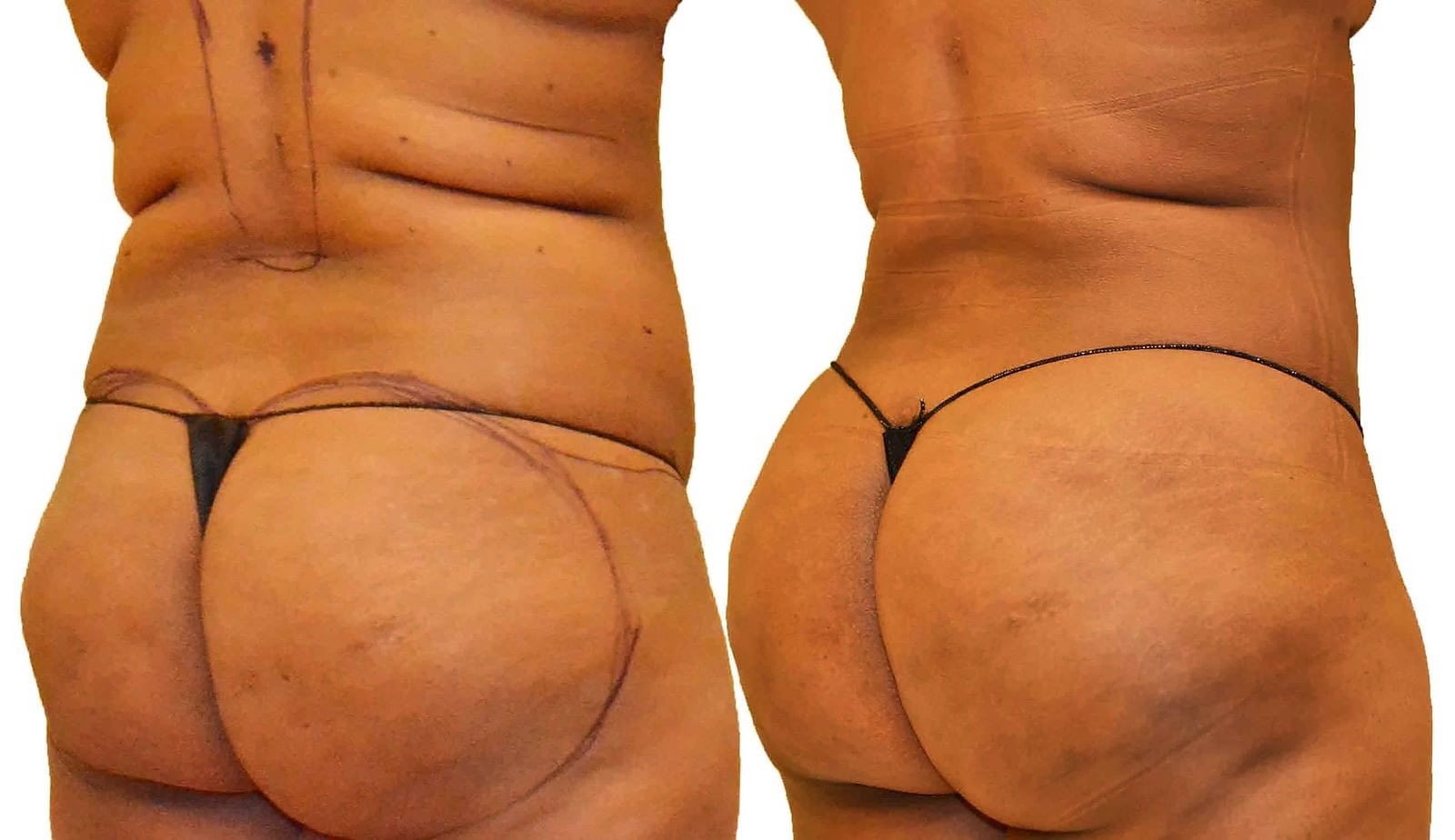 Fat Transfer, BBL before and after, actual patient of Dr. Long