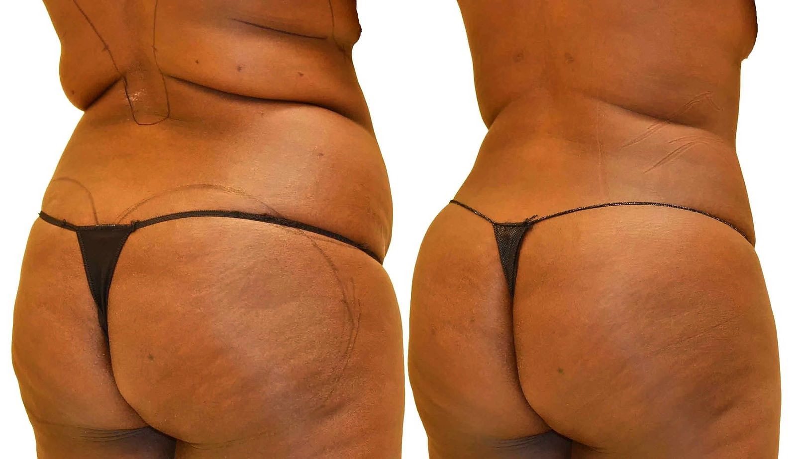 Fat Transfer, BBL before and after, actual patient of Dr. Long