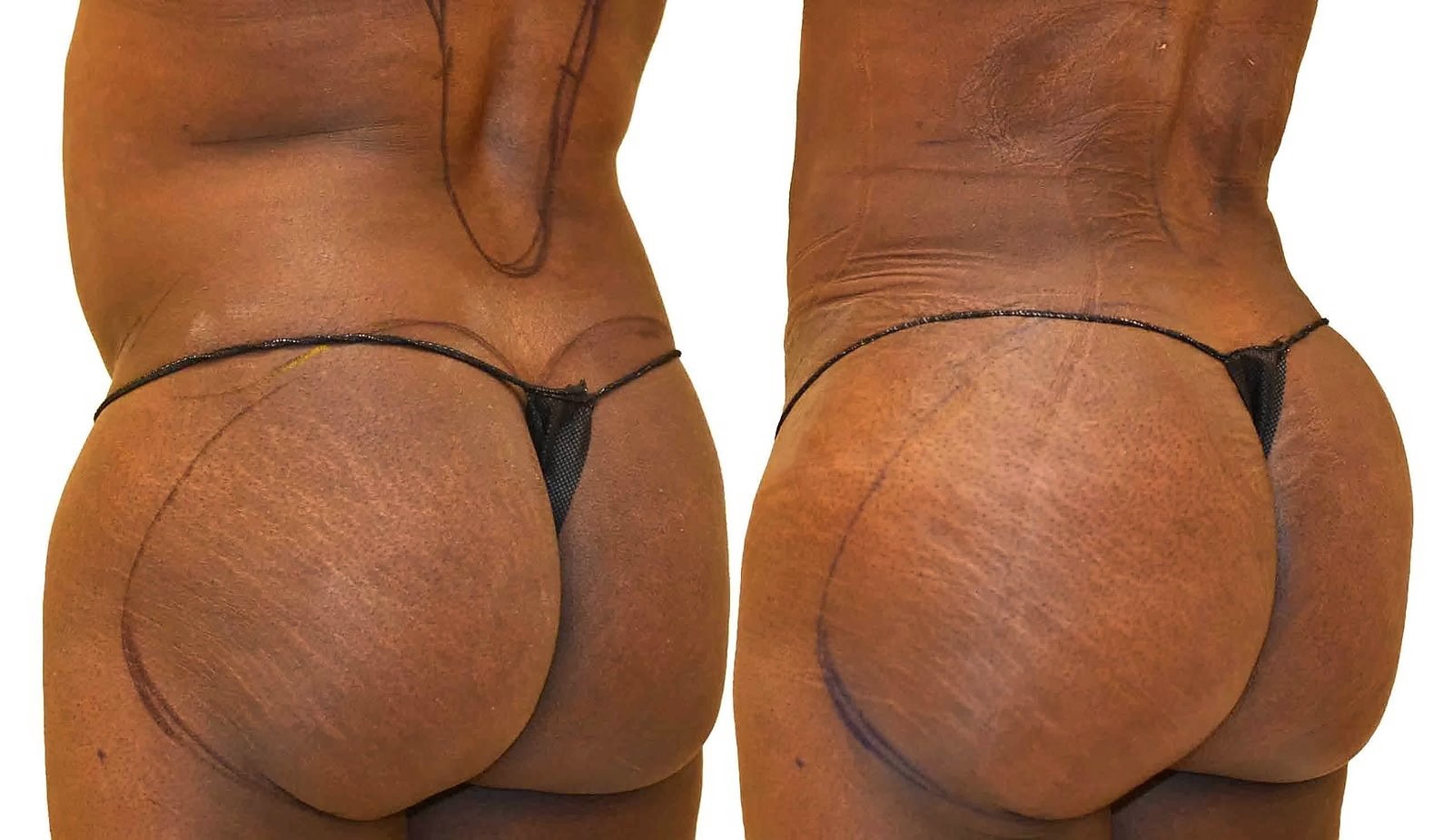 Fat Transfer, BBL before and after, actual patient of Dr. Long