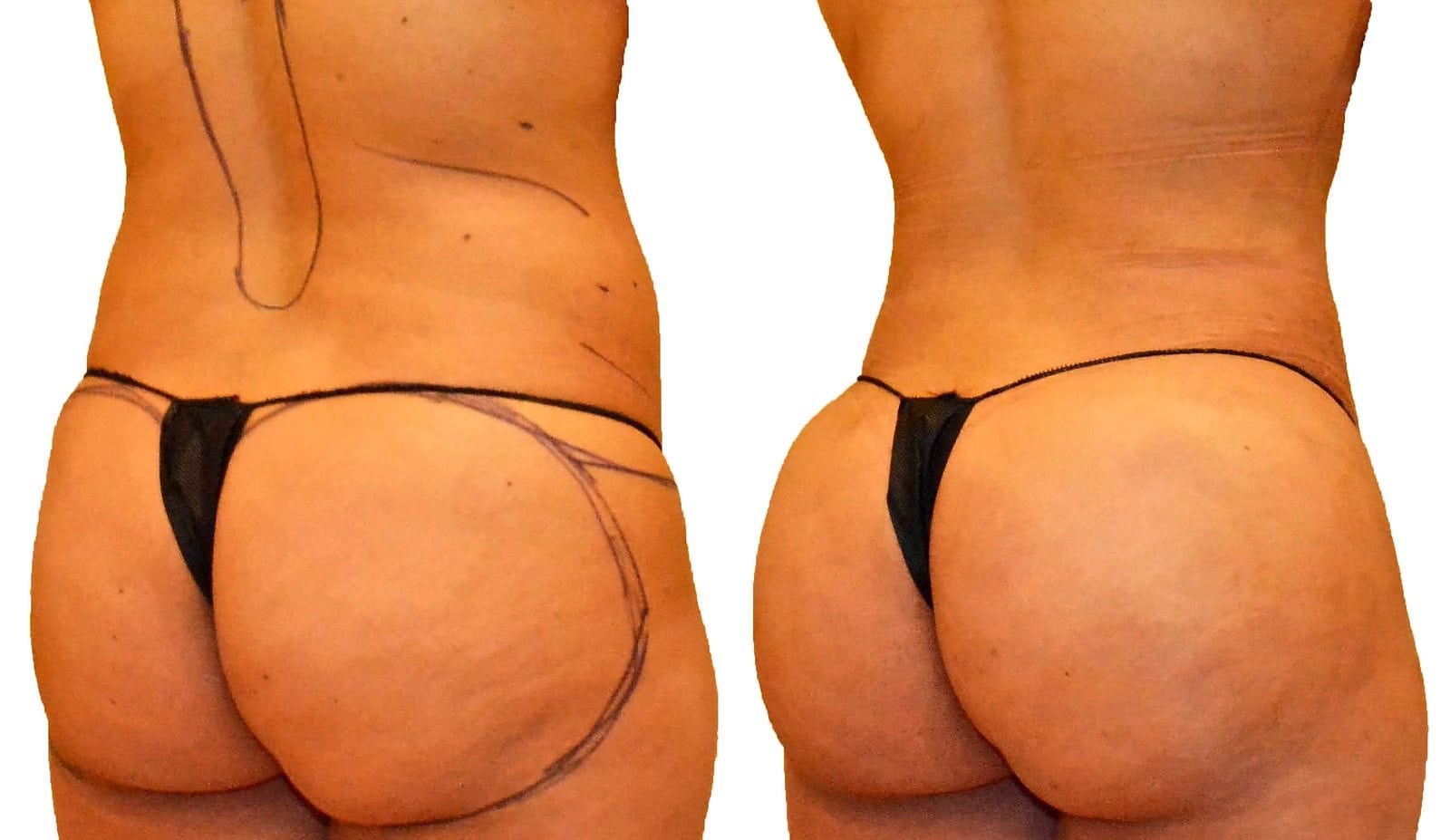 Fat Transfer, BBL before and after, actual patient of Dr. Long