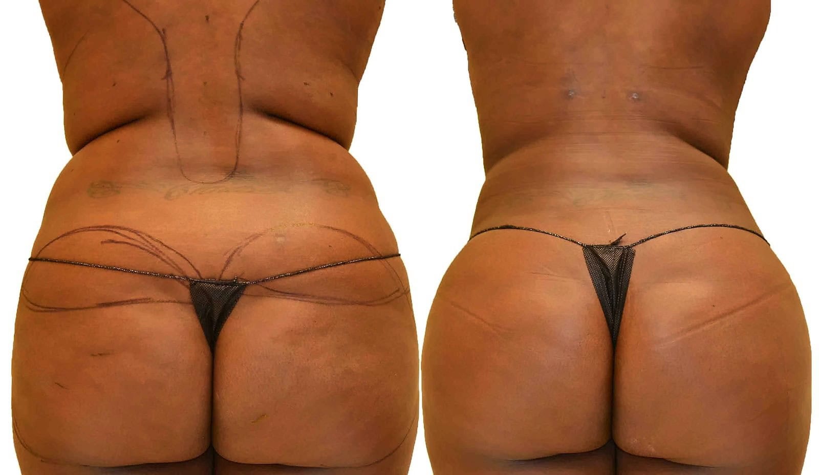 Fat Transfer, BBL before and after, actual patient of Dr. Long