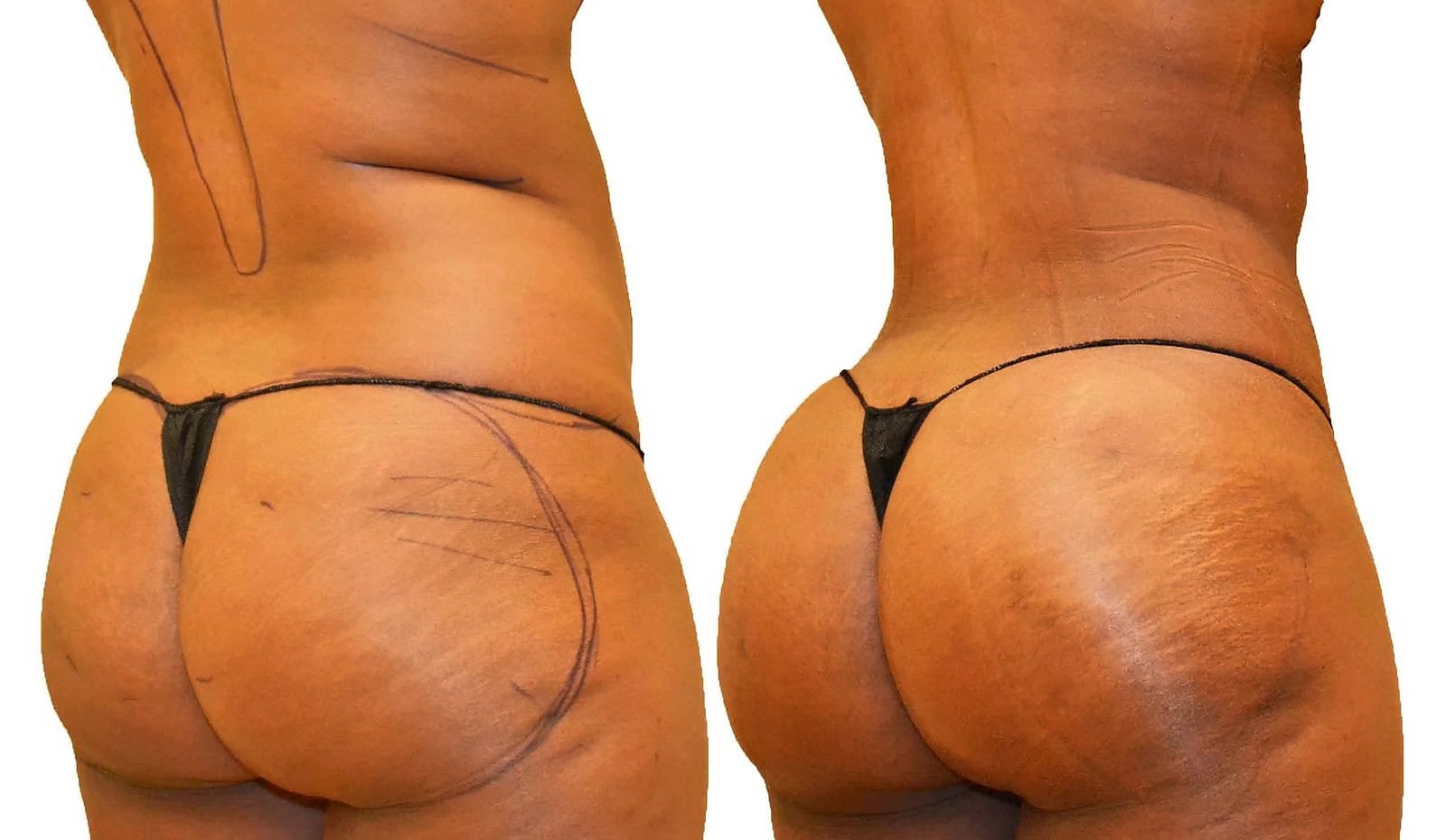Fat Transfer, BBL before and after, actual patient of Dr. Long
