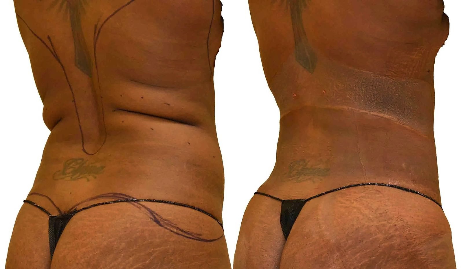 Lipo 360 before and after, actual patient of Dr. Long