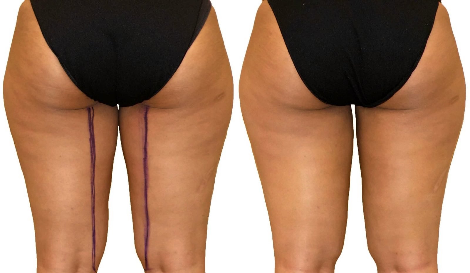 Thigh liposuction before and after, actual patient of Dr. Long