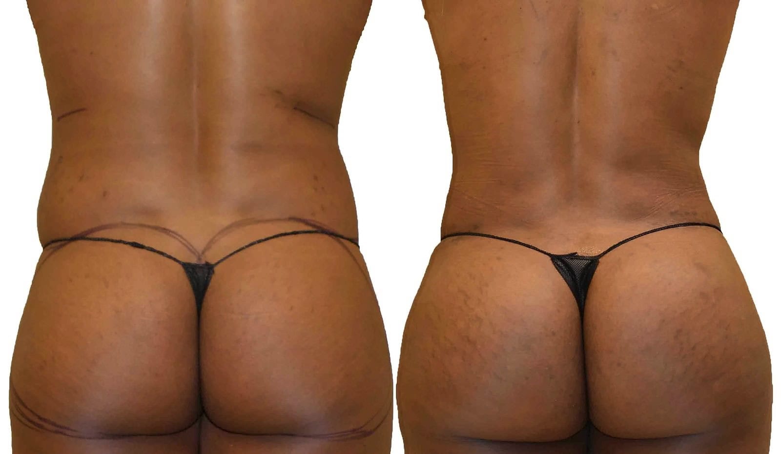 Fat Transfer, BBL before and after, actual patient of Dr. Long