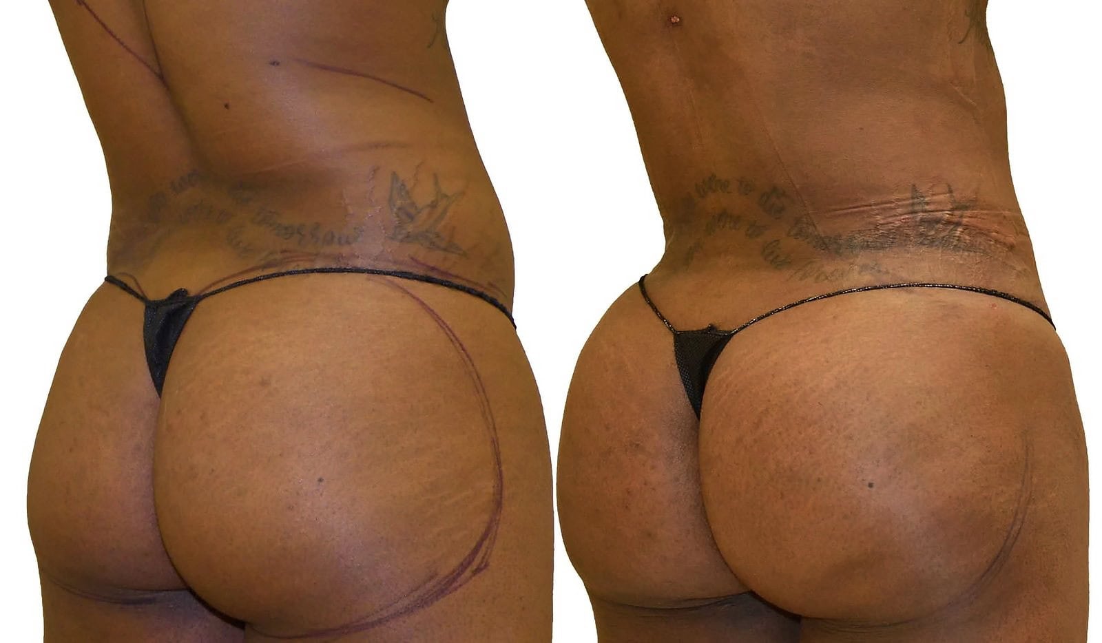 Fat Transfer, BBL before and after, actual patient of Dr. Long